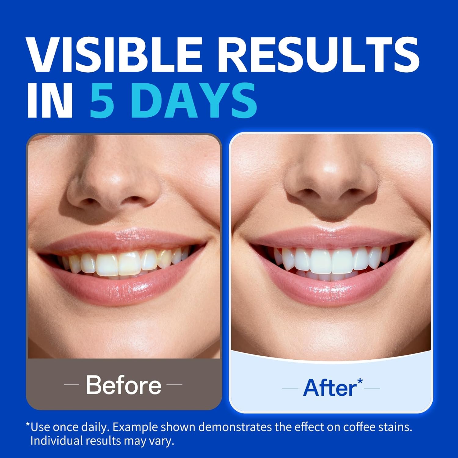 7 paia di strisce sbiancanti p - Teeth Whitening Street recensione e prezzo