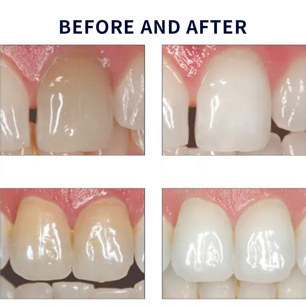Opalescence Whitening 20% PF 2 - Teeth Whitening Gel Peroxide recensione e prezzo