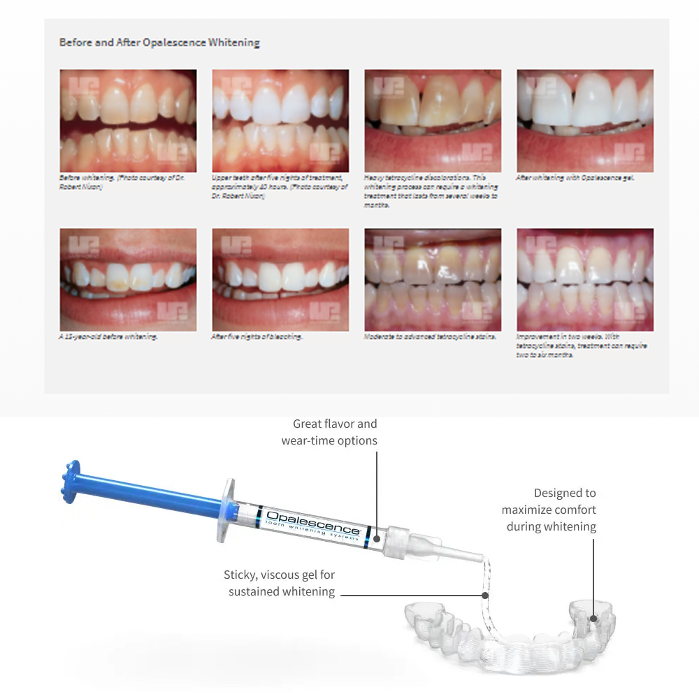 Opalescence Whitening 20% PF 2 - Teeth Whitening Gel Peroxide recensione e prezzo