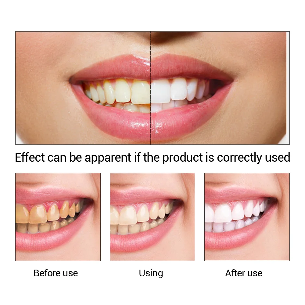 FTEENPLY Sbiancamento Dei Dent - Teeth Whitening Street recensione e prezzo