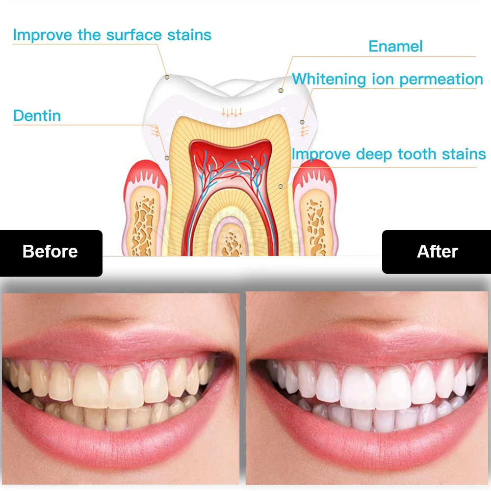 Kit per sbiancamento dei denti - Teeth Whitening Gel Peroxide recensione e prezzo