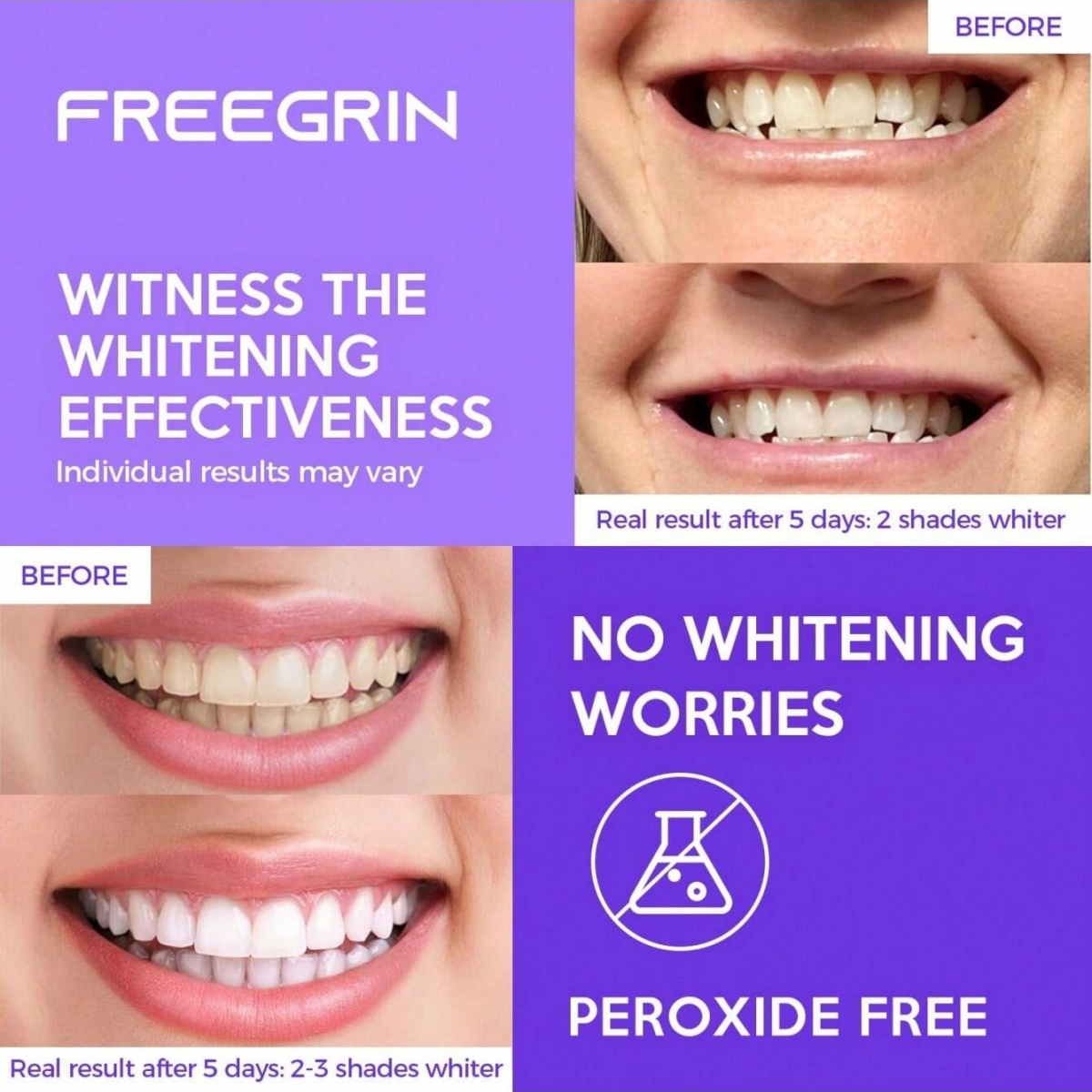 Adesivi sbiancanti per denti d - Teeth Whitening Gel Peroxide recensione e prezzo